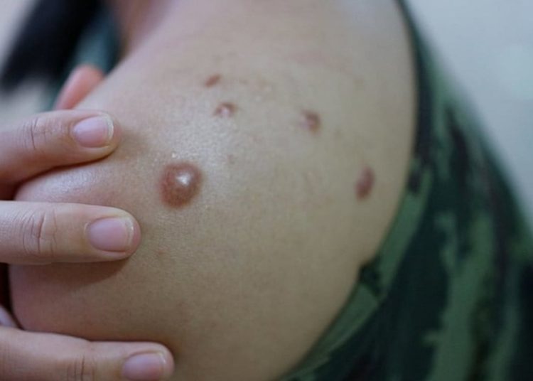 rio-ja-registra-mais-de-3-mil-notificacoes-de-mpox;-1.266-pessoas-estao-com-a-doenca