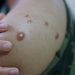 rio-ja-registra-mais-de-3-mil-notificacoes-de-mpox;-1.266-pessoas-estao-com-a-doenca