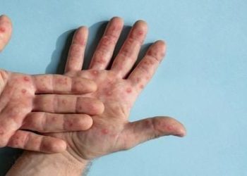 oms-faz-recomendacoes-temporarias-para-situacoes-de-surto-por-mpox