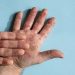 oms-faz-recomendacoes-temporarias-para-situacoes-de-surto-por-mpox