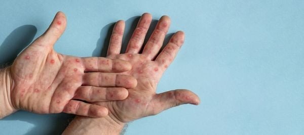oms-faz-recomendacoes-temporarias-para-situacoes-de-surto-por-mpox