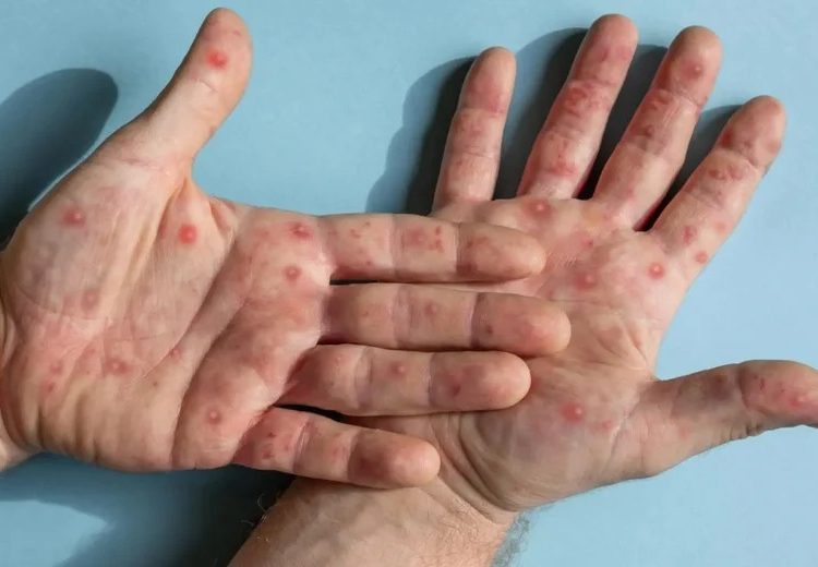 caso-suspeito-de-mpox-foi-registrado-em-campos-e-saude-alerta-para-cuidados