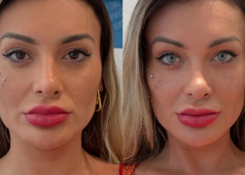 andressa-urach-relata-dor-apos-cirurgia-para-mudar-cor-dos-olhos:-‘estou-arrependida-de-ter-feito’-–-jovem-pan