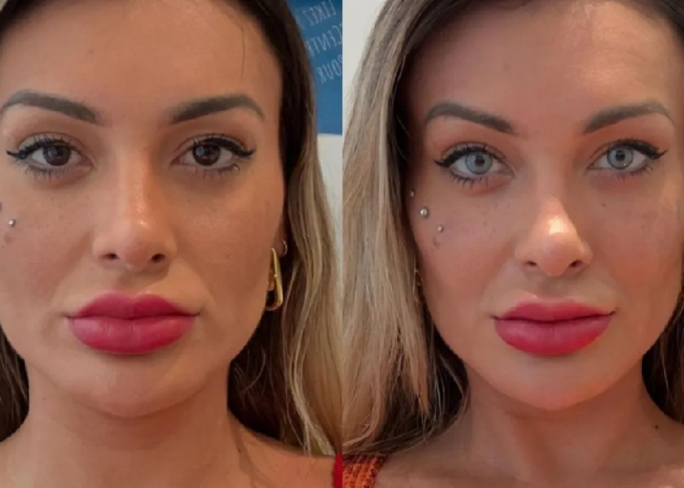 andressa-urach-relata-dor-apos-cirurgia-para-mudar-cor-dos-olhos:-‘estou-arrependida-de-ter-feito’-–-jovem-pan