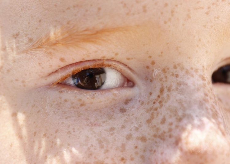 Reflexo branco nos olhos: entenda condição que assusta pais