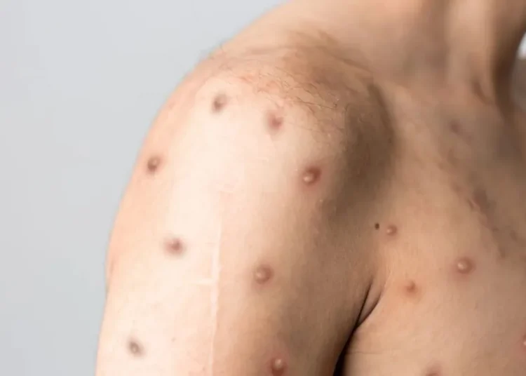 Saúde reforça alerta para Mpox e orienta população sobre sintomas