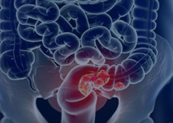 Rastreamento para câncer colorretal pode ser implementado no SUS