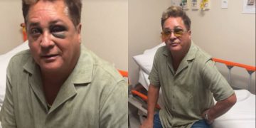 Cantor Leonardo sofre acidente e aparece com olho roxo