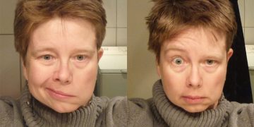 Choque térmico causa paralisia facial? Entenda os sintomas e as causas reais