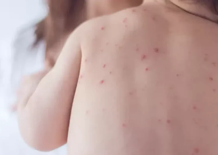 Estado de São Paulo reforça necessidade de vacinação contra o sarampo