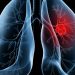 Saiba o que é adenocarcinoma pulmonar, câncer que atinge o Papa Leão