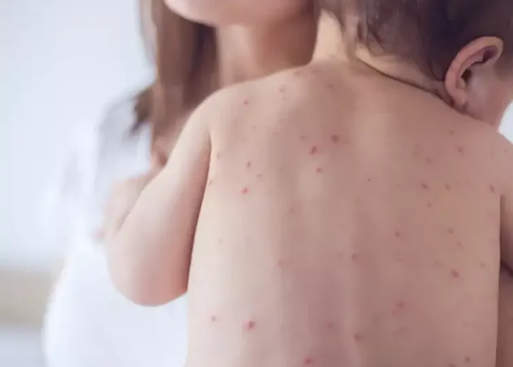 Negacionismo impulsiona sarampo nos EUA e representa ameaça ao Brasil